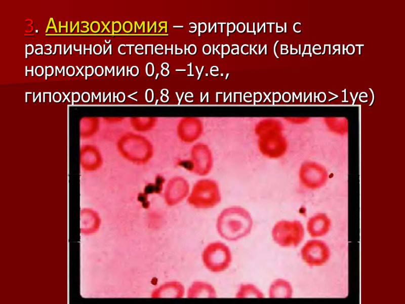 3. Анизохромия – эритроциты с различной степенью окраски (выделяют нормохромию 0,8 –1у.е.,  гипохромию<